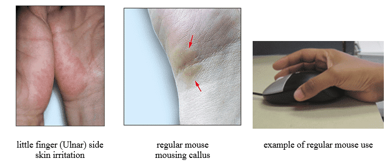גירוי עור כף היד בשימוש בעכבר טופ קומרס